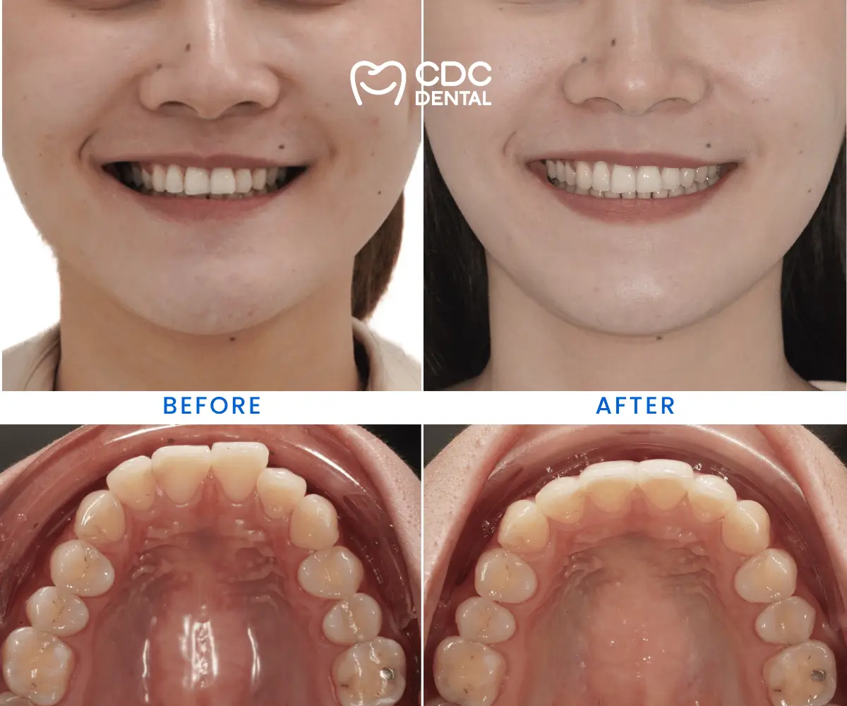 Before Treatment