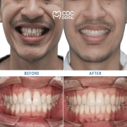 Invisalign Clear Aligners Case: Achieving a Straight and Confident Smile Without Braces