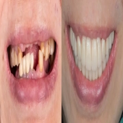 Full Mouth Reconstruction/Rehabilitation