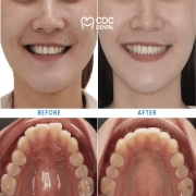Invisalign Clear Aligners Case: Correcting Crowded Front Teeth with a Natural Smile Transformation