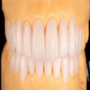 Bespoke Smile Makeover