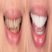 Bespoke Smile Makeover