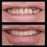 Successful Root Canal Treatment to Save a Damaged Tooth in Thailand | Endodontic Case Study