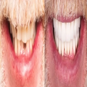 Full Mouth Reconstruction/Rehabilitation