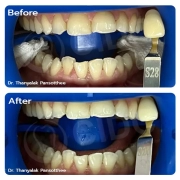 Teeth Whitening Treatment in Thailand: Restore a Brighter and More Confident Smile | Case Study