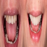 Full Mouth Reconstruction/Rehabilitation