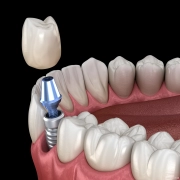 Introducing Our Advanced Dental Implant System – The Future of Tooth Replacement