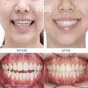 Invisalign Clear Aligner Treatment in Thailand | Invisible Braces Case for a Confident Smile