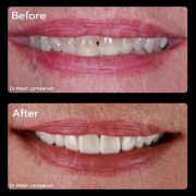Front Tooth Root Canal Treatment in Thailand | Save Your Natural Tooth | Endodontic Case Study