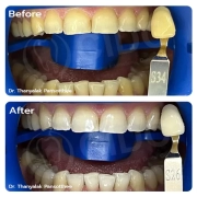 Professional Teeth Whitening in Thailand for a Brighter Smile | Whitening Treatment Case Study
