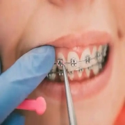 Fixed Orthodontic Treatment: Reliable Solutions for a Straighter Smile