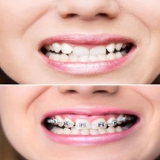 Popular Orthodontic Treatments Abroad: Exploring Modern Options for a Straighter Smile