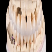 Full Mouth Reconstruction/Rehabilitation