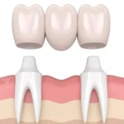 Confused Between Dental Implants and Bridges? Stop Choosing Blindly! A Dentist Reveals the Truth