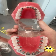 Lingual Orthodontics: The Invisible Solution Behind Your Smile