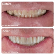 Porcelain Veneers in Thailand: Transform Your Smile with Natural-Looking Results | Dental Veneer Case