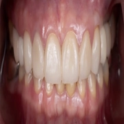 Full Mouth Reconstruction/Rehabilitation
