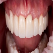 Full Mouth Reconstruction/Rehabilitation