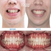 Invisalign Treatment in Thailand | Clear Aligner Orthodontic Case for a Perfect Smile